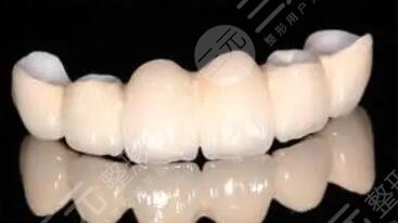 烤瓷牙