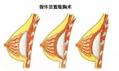 韓國蓓拉假體的價(jià)格貴嗎？