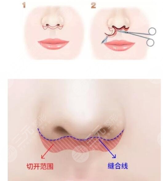 北京張曼醫(yī)生人中縮短技術(shù)好嗎?