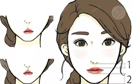 北京張曼醫(yī)生人中縮短手術(shù)之后有哪些注意事項(xiàng)呢?