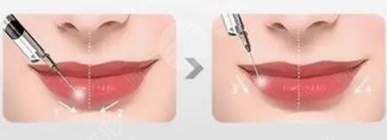 張曼醫(yī)生做唇排名第幾？醫(yī)生特點介紹，唇部整形案例來襲！