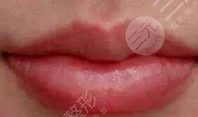 張曼醫(yī)生做唇排名第幾？醫(yī)生特點介紹，唇部整形案例來襲！