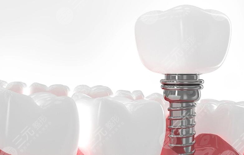 上海半口牙齒種植需要多少錢?一顆費(fèi)用6000元起|半口種植牙15萬不等