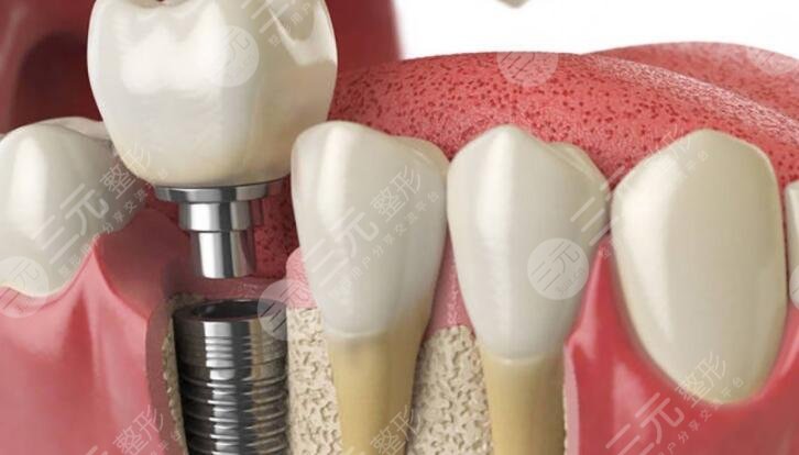 上海做半口牙齒種植應(yīng)該怎樣選擇醫(yī)院?