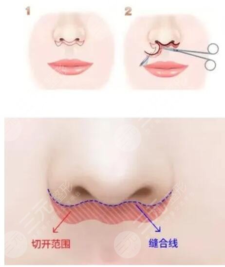 北京張曼美容醫(yī)生怎么樣？個人資料，擅長唇部整形與人中縮短手術