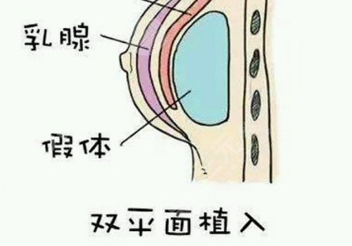 雙平面假體隆胸弊端優(yōu)缺點