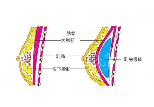雙平面假體隆胸弊端優(yōu)缺點