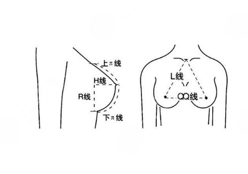 雙平面假體隆胸弊端優(yōu)缺點