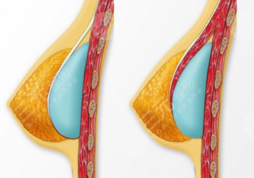 雙平面假體隆胸弊端優(yōu)缺點