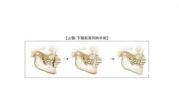 科普頜面畸形的調(diào)整過(guò)程，重塑臉型!