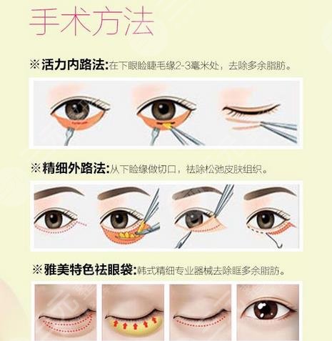 北京宋俊嶺醫(yī)生去眼袋案例