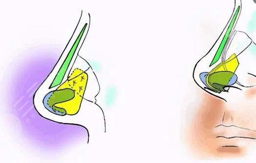安醫(yī)大一附屬醫(yī)院整形科隆鼻專家