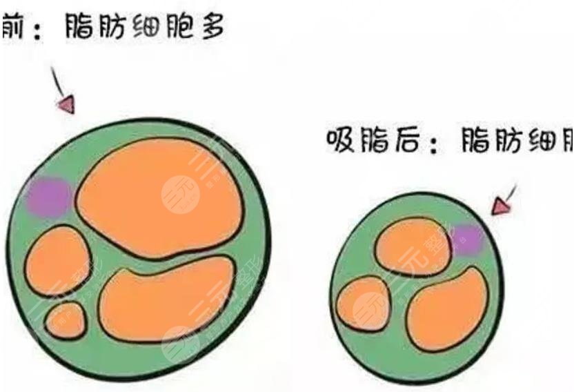 上海八院美容科吸脂減肥案例