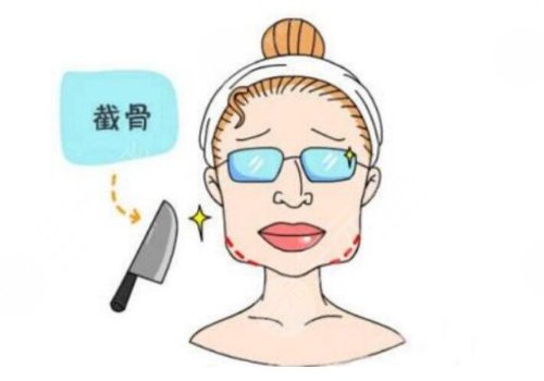 下頜角整形手術(shù)