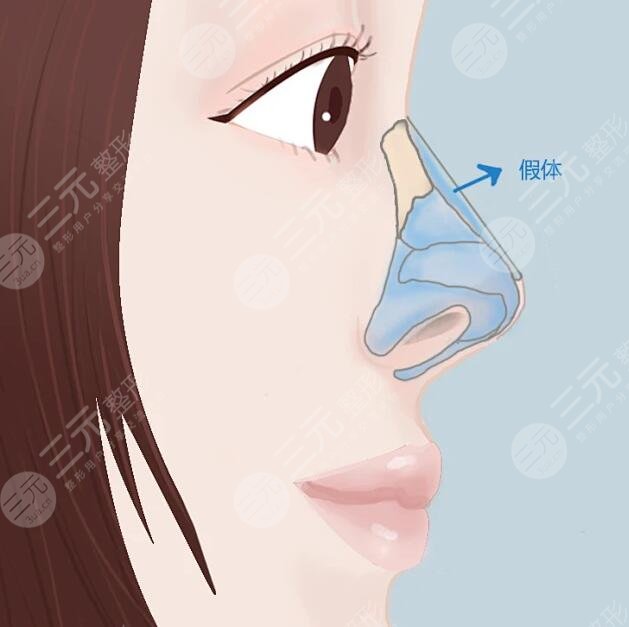 鼻部整形手術(shù)