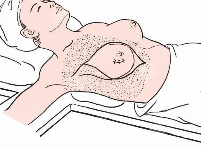 雙平面隆胸優(yōu)點(diǎn)