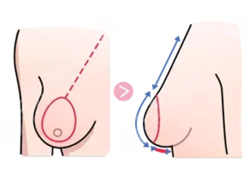 縮胸手術(shù)真實案例前后對比圖案例分享