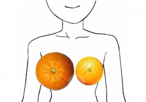 縮胸手術(shù)真實案例前后對比圖案例分享