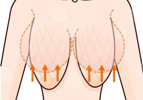 上海九院做胸下垂緩解好嗎，多少錢