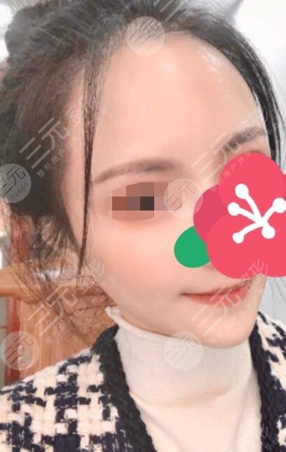 劉文先醫(yī)生玻尿酸注射填充太陽(yáng)穴案例