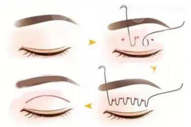 上海第六人民醫(yī)院美容科特色項(xiàng)目