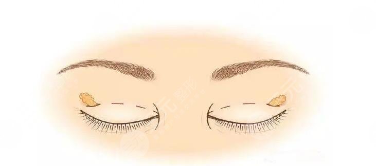 北京積水潭醫(yī)院劉巖和楊凱哪個(gè)擅長?做雙眼皮手術(shù)