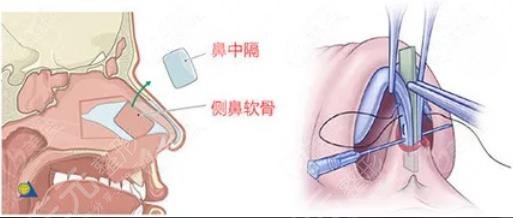 鄭若冰鼻子整形怎么樣