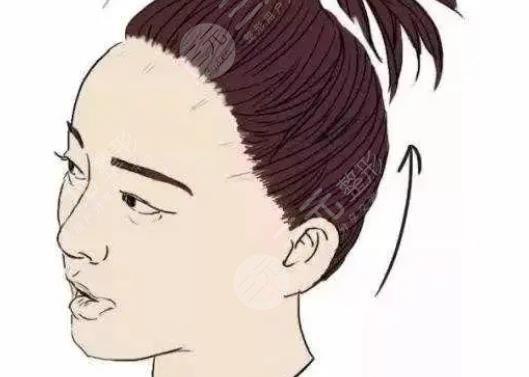 發(fā)際線種植