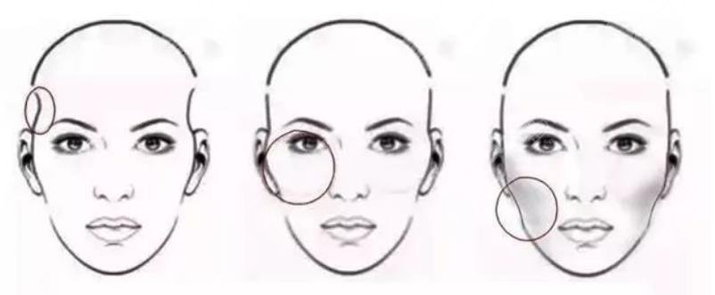 太陽(yáng)穴凹陷