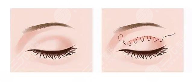 北京八大處林琳醫(yī)生全切雙眼皮案例分享