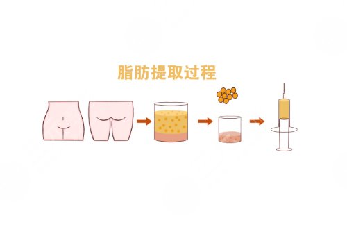 自體脂肪豐胸手術費大概要多少錢