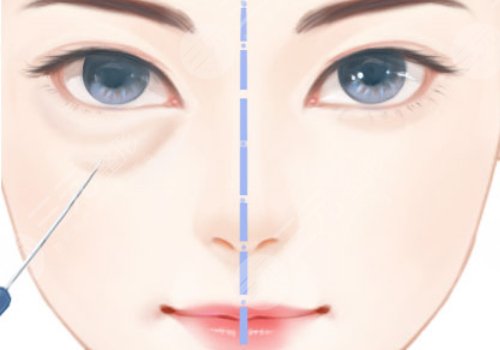 上海九院做眼袋手術(shù)多少錢 