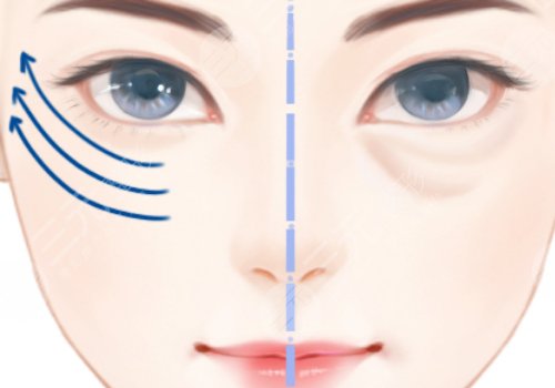 上海九院做眼袋手術(shù)多少錢 