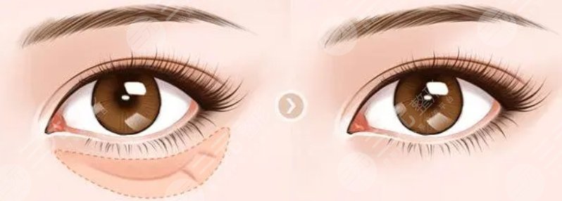 萬州三峽醫(yī)院去眼袋案例