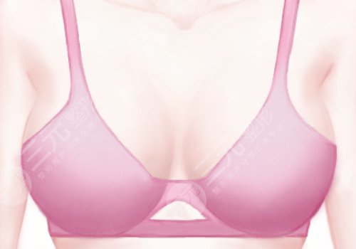 自體脂肪隆胸可以保持幾年