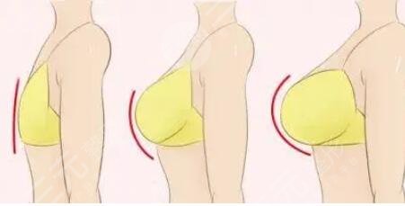 隆胸隆胸修復(fù)