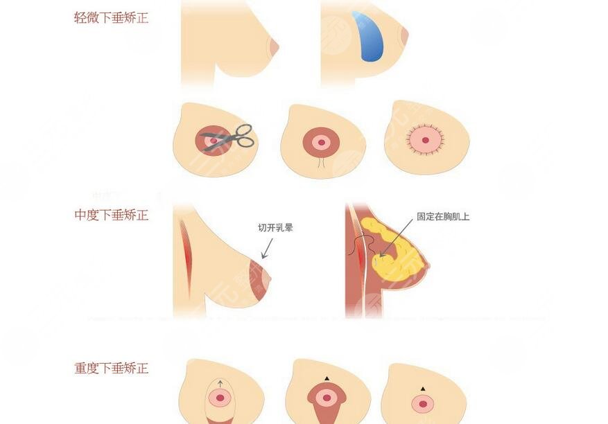 乳房懸吊手術(shù)保持幾年