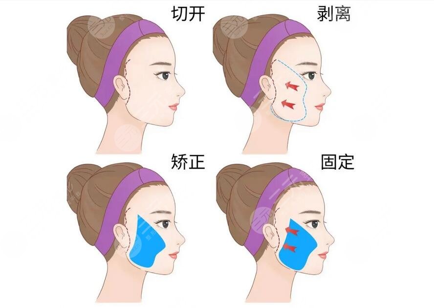 徐國建醫(yī)生拉皮手術(shù)費(fèi)用是多少