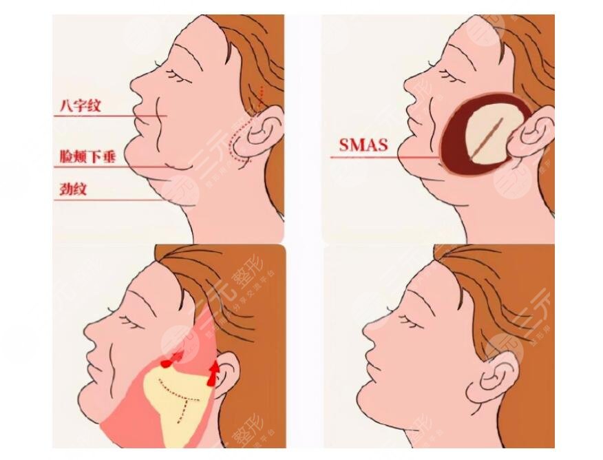 徐國建醫(yī)生拉皮手術(shù)費(fèi)用是多少