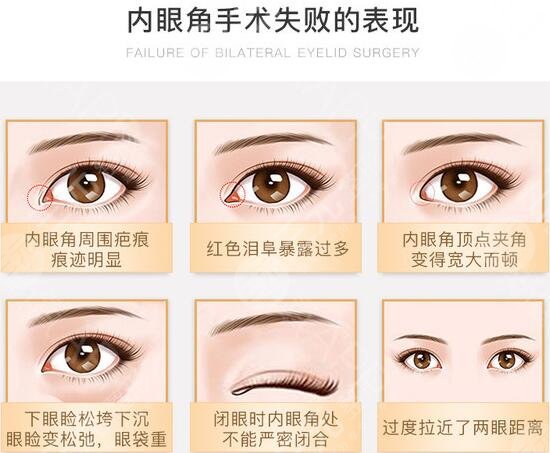 合肥李小靜眼角回包修復案例分享！安醫(yī)熱門整形醫(yī)生，等你品評~