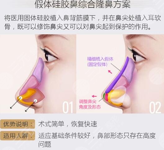 張明興個(gè)人資料及圖片案例分享，廣州華美熱門醫(yī)生，隆鼻好評(píng)多！