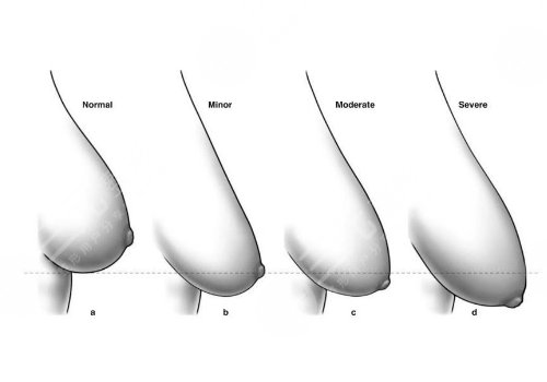 胸下垂外擴(kuò)有什么辦法能挺起來