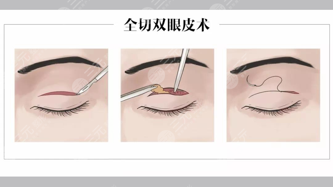 合肥李小靜雙眼皮案例分享！安醫(yī)附院整形實(shí)力派，醫(yī)生風(fēng)格揭秘~