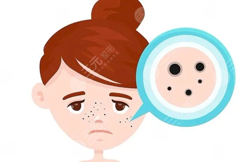 李曉陽醫(yī)生激光祛斑案例