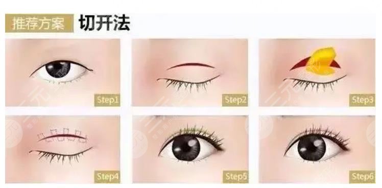 趙雷醫(yī)生雙眼皮整形案例