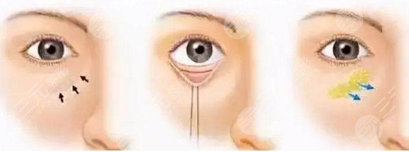 趙自然醫(yī)生眼袋祛除案例