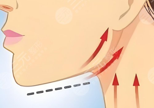 下顎線整形多少錢(qián)