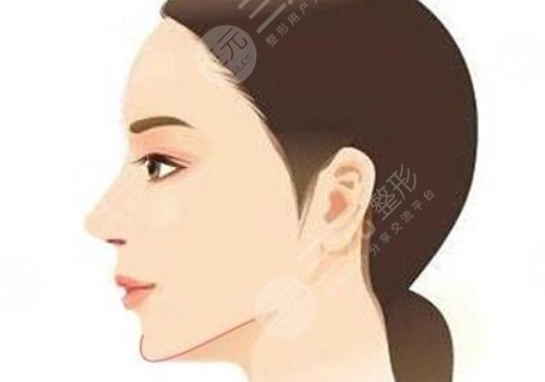 下顎線整形多少錢(qián)