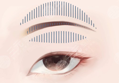 雙眼皮下垂怎么解決