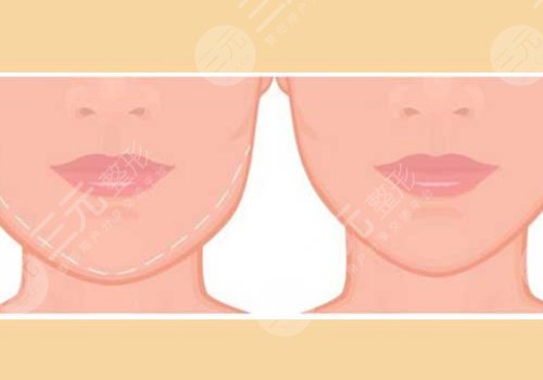 下頜骨歪了怎么矯正